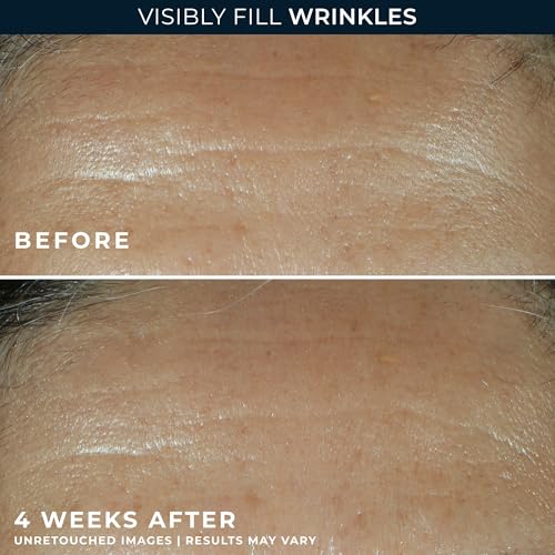 Retinol Correxion Wrinkle Filler for Deep Wrinkles with Hyaluronic Acid