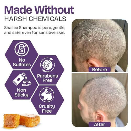 and Folliculitis Treatment - Seborrheic Dermatitis Antifungal Shampoo for Ringworm
