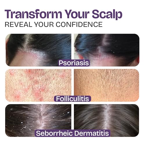and Folliculitis Treatment - Seborrheic Dermatitis Antifungal Shampoo for Ringworm