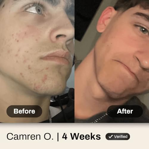 Face Acne System for Men and Boys