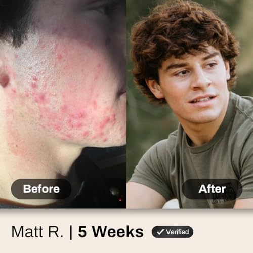 Face Acne System for Men and Boys