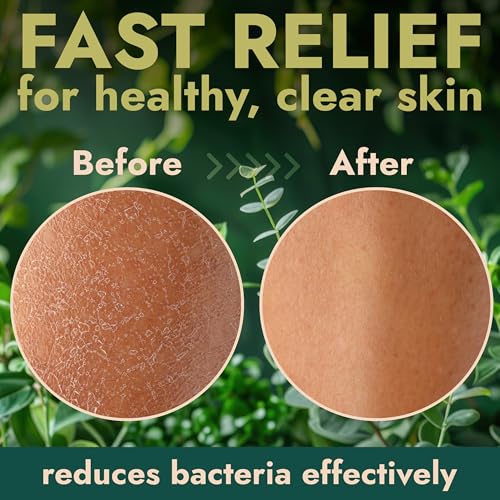 Antibacterial Body Wash for Back Acne, Body Odor & Skin Irritation 16 oz