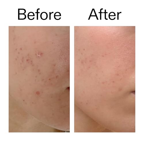 Mandelic Acid Treatment 10% 0.5 fl oz