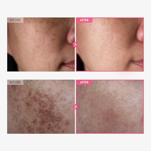 Arbutin 7% + Tranexamic Acid 4% Cream for Dark Spots