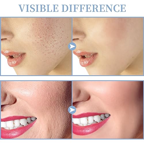 High Frequency Facial Machine Portable Handheld