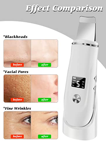 Skin Scrubber Face Spatula 4 in 1 Blackhead Remover