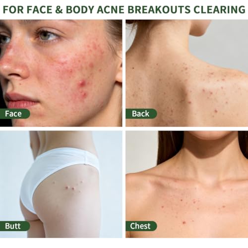 Acne Treatment for Face Hormonal Cystic Acne Treatment Cream Salicylic Acid Acne Cream for