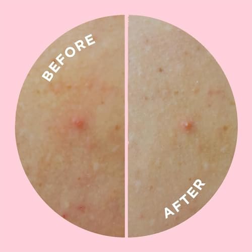 Large Pimple Patches for Face and Body 9 Count